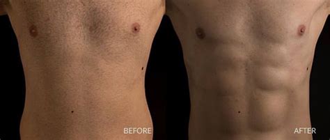 male liposuction miami|Best Male Liposuction Miami, FL 